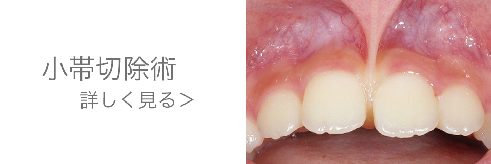小帯切除術