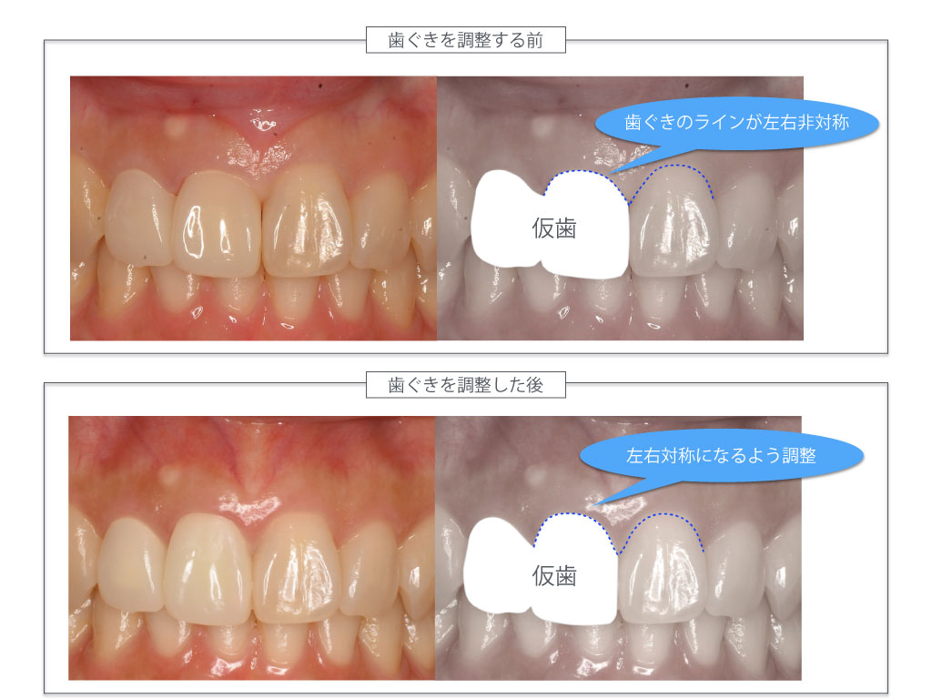 歯茎を調整する前・調整した後