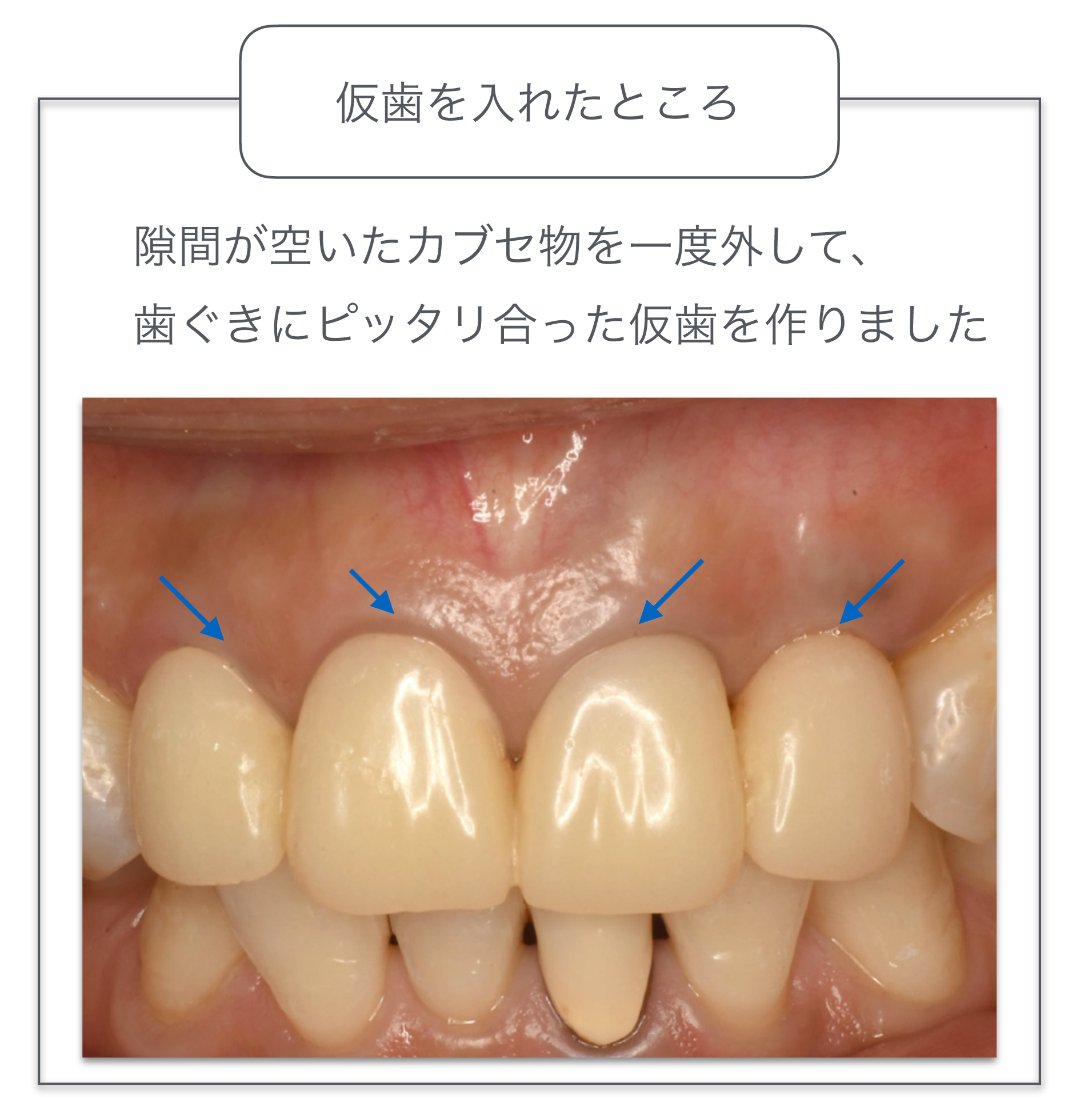 仮歯を入れたところ