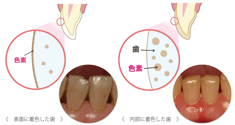 クリーニングとホワイトニング